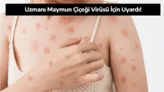 Uzmanı Maymun Çiçeği Virüsü İçin Uyardı!